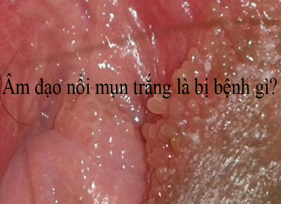Âm đạo nổi mụn trắng là bị bệnh gì?