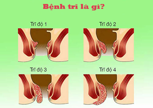 Bệnh trĩ là gì? dấu hiệu, triệu chứng, cách chữa trị