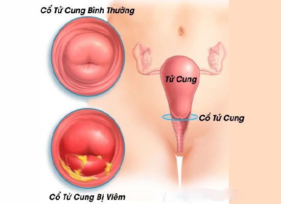 Viêm cổ tử cung: nguyên nhân và cách chữa