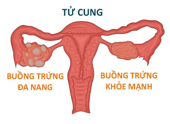 Buồng trứng đa nang là gì? Có nguy hiểm không