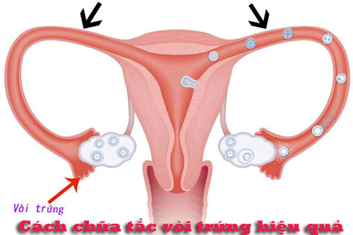 10 Cách chữa tắc vòi trứng hiệu quả nhất hiện nay