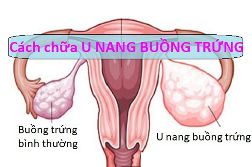 Cách chữa u nang buồng trứng Cách chữa u nang buồng trứng