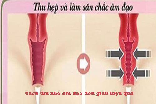 11 cách thu nhỏ âm đạo đơn giản hiệu quả tại nhà