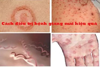 12 Cách chữa bệnh giang mai ở nữ, nam giới tại nhà hiệu quả