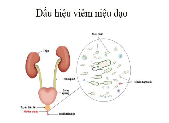 Dấu hiệu viêm niệu đạo ở nam, nữ giới