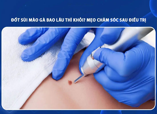 Đốt sùi mào gà bao lâu thì khỏi, có đau không