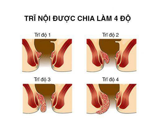 12 Hình ảnh bệnh trĩ nội, trĩ ngoại, trĩ hỗn hợp