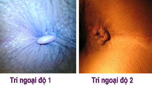 Hình ảnh bị bệnh trĩ ngoại 