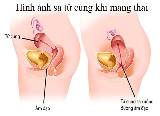 Hình ảnh sa tử cung khi mang thai