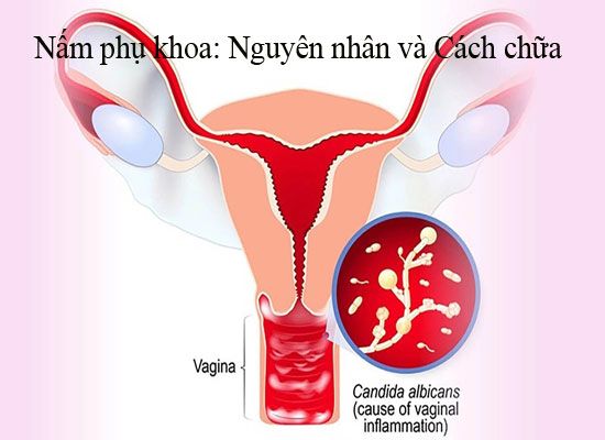 Nấm phụ khoa: Nguyên nhân và Cách chữa