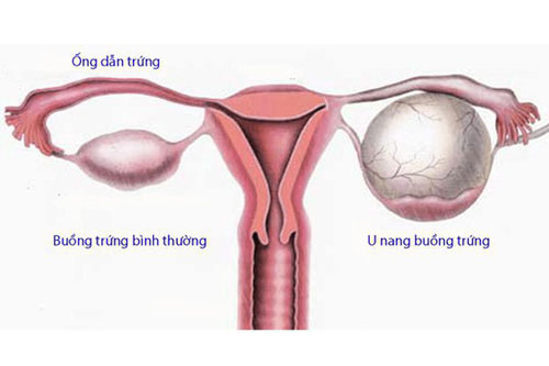 U nang buồng trứng có nguy hiểm không? cách chữa