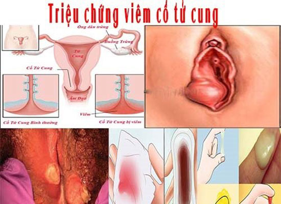 Triệu chứng viêm cổ tử cung thường gặp
