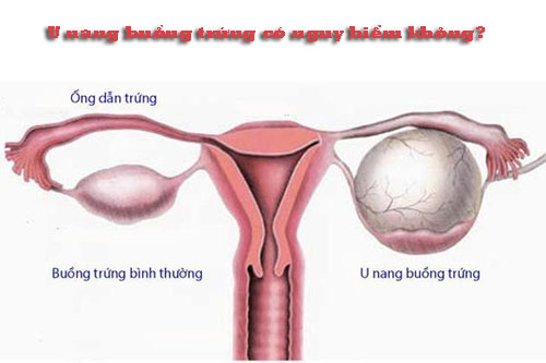 U nang buồng trứng có nguy hiểm không? U nang buồng trứng có nguy hiểm không?