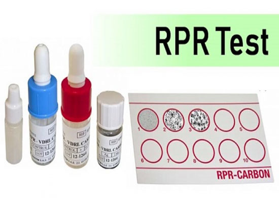 9 Bước xét nghiệm RPR cần lưu ý