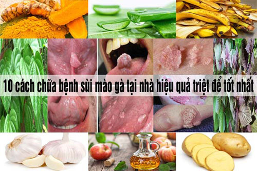 Cách chữa bệnh sùi mào gà hiệu quả nhất tại nhà
