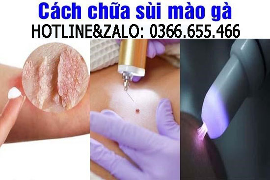Cách chữa bệnh sùi mào gà hiệu quả nhất tại nhà