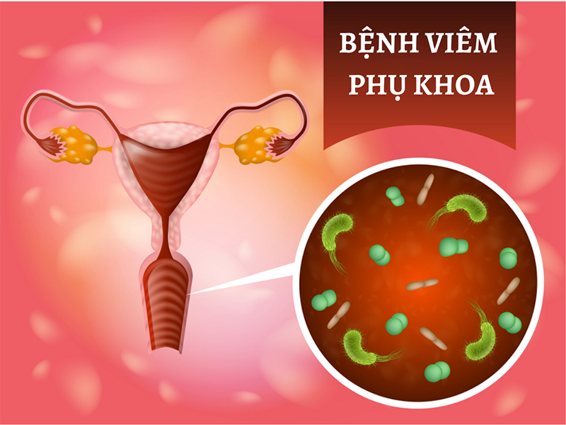Viêm phụ khoa là gì