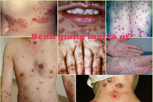 Bệnh giang mai là gì? dấu hiệu, biểu hiện và cách chữa trị