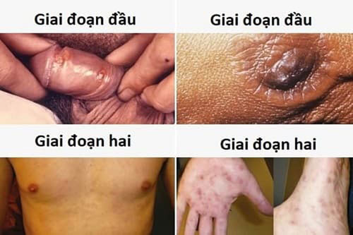Xét nghiệm bệnh giang mai bao lâu thì có kết quả