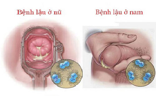 Bệnh lậu là gì: dấu hiệu, triệu chứng và cách chữa trị