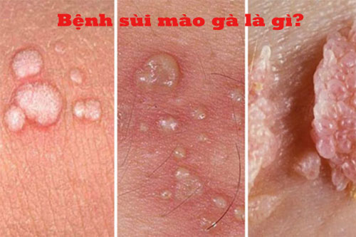 Bệnh sùi mào gà là gì? dấu hiệu, triệu chứng và cách điều trị