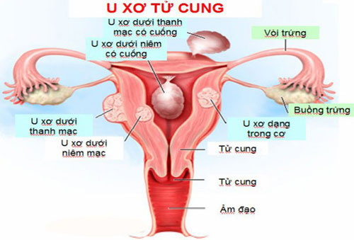 Bệnh u xơ tử cung có nguy hiểm không Bệnh u xơ tử cung có nguy hiểm không