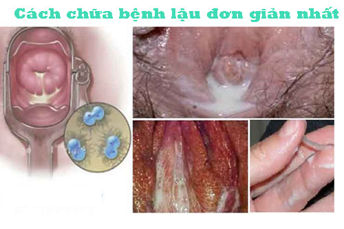 15 Cách chữa bệnh lậu đơn giản hiệu quả tốt nhất tại nhà