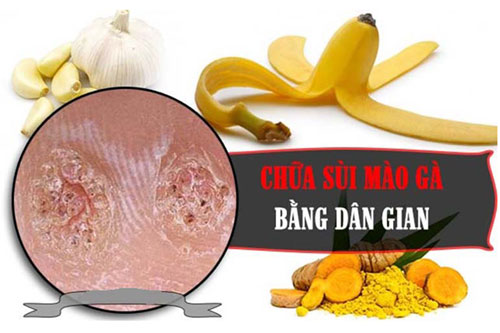 Cách chữa bệnh sùi mào gà Cách chữa bệnh sùi mào gà