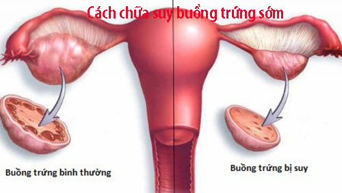Cách chữa suy buồng trứng sớm Cách chữa suy buồng trứng sớm