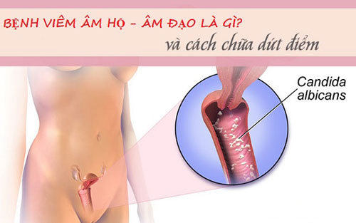 Cách chữa trị viêm âm hộ