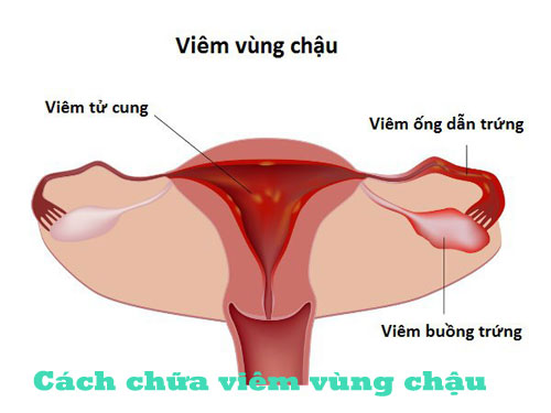 Cách chữa viêm vùng chậu