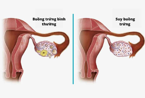 Dấu hiệu suy buồng trứng sớm Dấu hiệu suy buồng trứng sớm