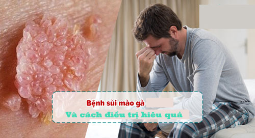 Điều trị sùi mào gà hiệu quả