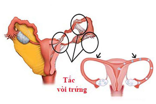 Tắc vòi trứng: nguyên nhân, triệu chứng và cách chữa