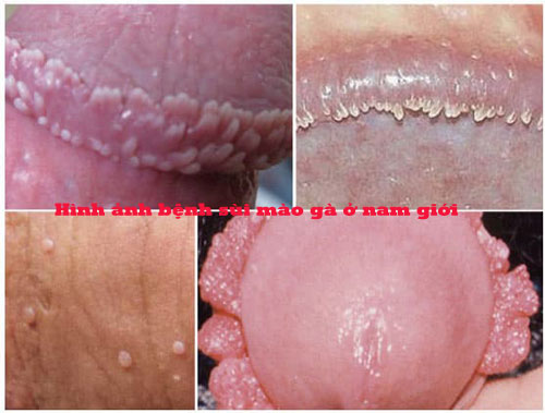 Hình ảnh bệnh sùi mào gà ở nam giới