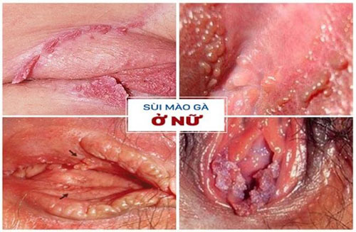 Hình ảnh bệnh sùi mào gà ở nữ giới