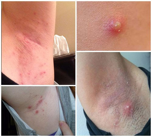 Mọc mụn ở nách là bệnh gì? có nguy hiểm không? cách khác phục