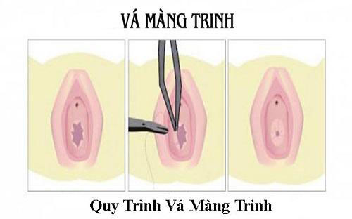 Một số thông tin về màng trinh