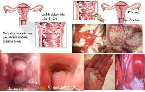 Nguyên nhân gây nên tình trạng viêm âm đạo Nguyên nhân gây nên tình trạng viêm âm đạo