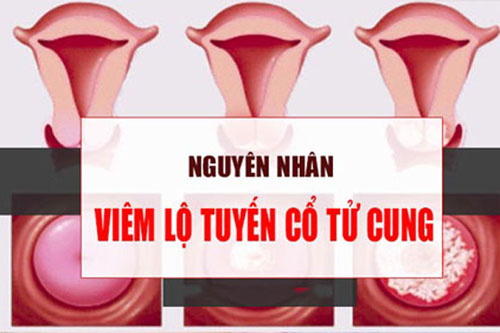 Nguyên nhân gây viêm lộ tuyến cổ tử cung Nguyên nhân gây viêm lộ tuyến cổ tử cung