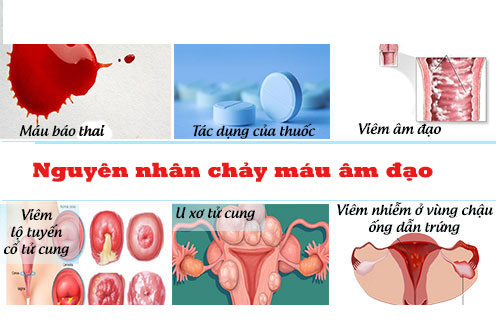Nguyên nhân nào gây nên chảy máu âm đạo Nguyên nhân nào gây nên chảy máu âm đạo