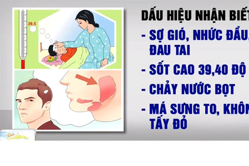 Nhận biết các triệu chứng quai bị thường gặp Nhận biết các triệu chứng quai bị thường gặp