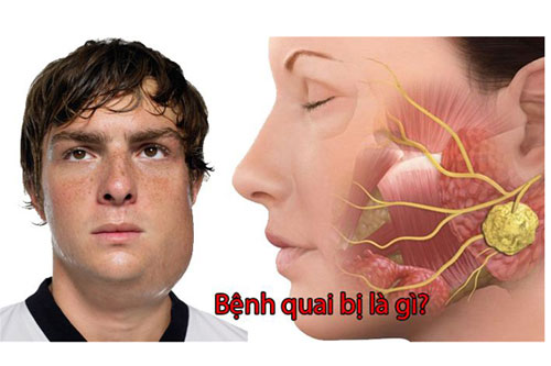 Quai bị là gì? Dấu hiệu triệu chứng và cách khắc phục