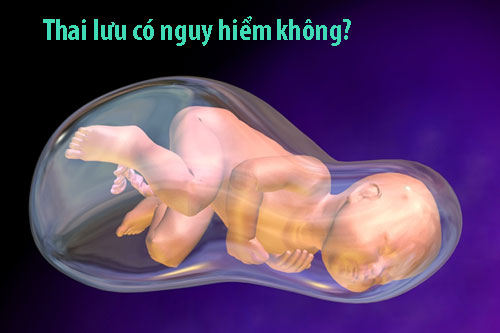 Thai lưu có nguy hiểm không?
