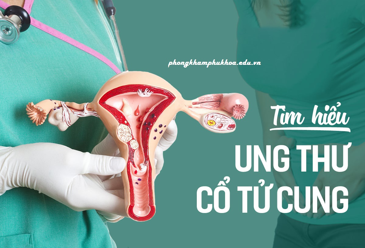 Cách điều trị ung thư cổ tử cung theo từng giai đoạn