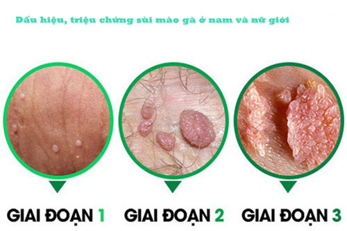 Triệu chứng sùi mào gà Triệu chứng sùi mào gà