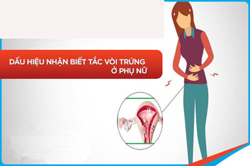 Triệu chứng tắc vòi trứng Triệu chứng tắc vòi trứng