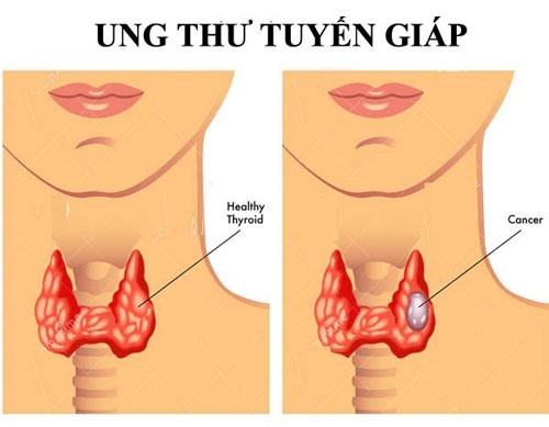 Ung thư tuyến giáp Ung thư tuyến giáp