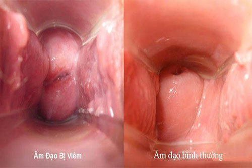 Viêm âm đạo: Nguyên nhân, triệu chứng, chẩn đoán và điều trị