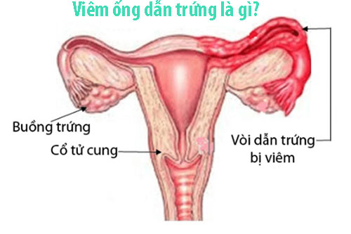 Viêm ống dẫn trứng: Nguyên nhân, triệu chứng và cách chữa